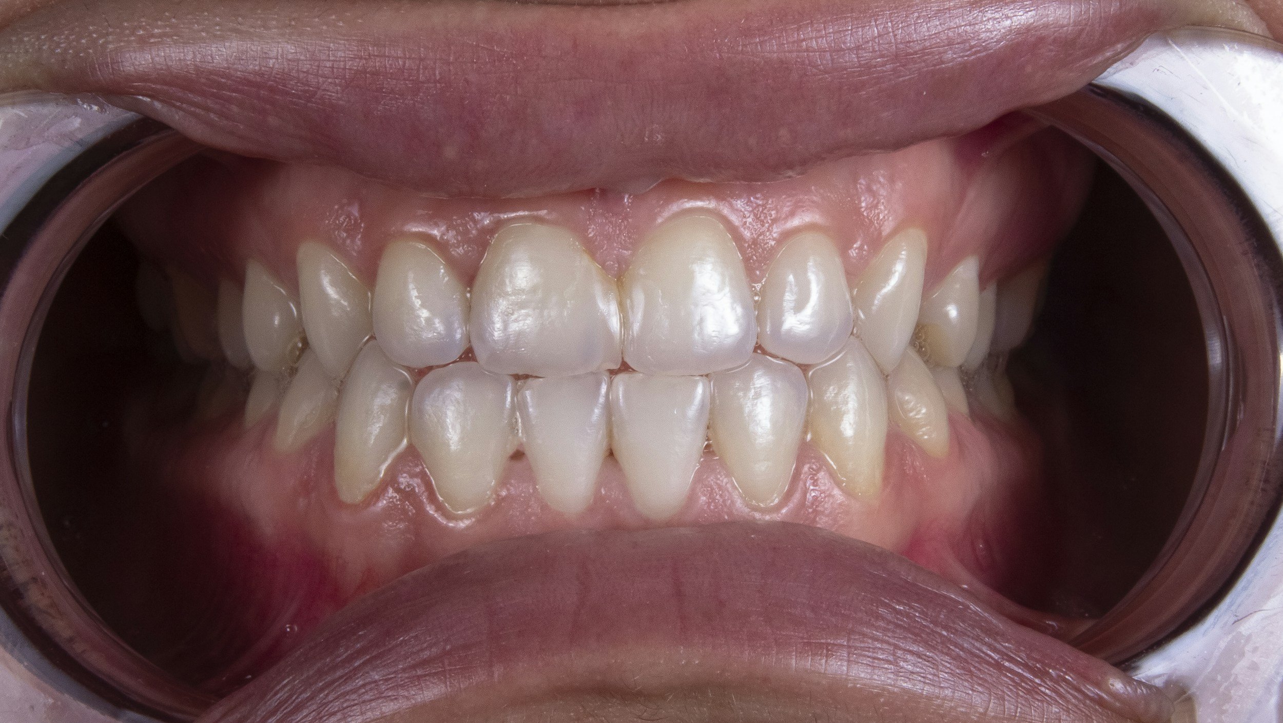 Why are turkey teeth popular